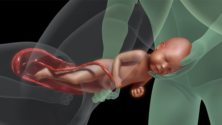 Most babies with CDH are delivered vaginally at term if there are no obstetric issues 