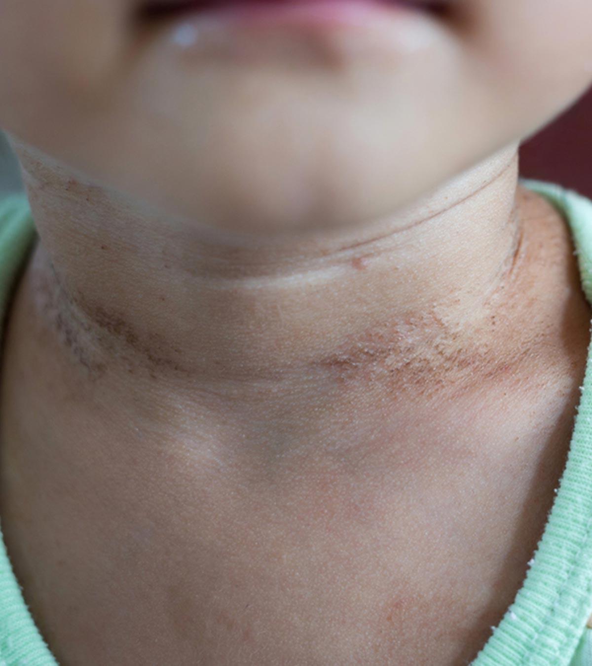 श श ओ और बच च म स र यस स छ ल र ग क रण लक षण व उपच र Psoriasis In Babies In Hindi