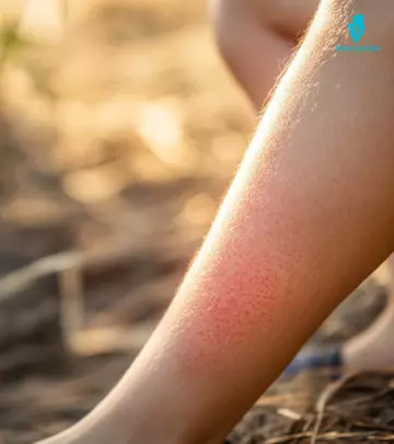 Infections, friction, and trauma may cause these spots to appear on the skin.