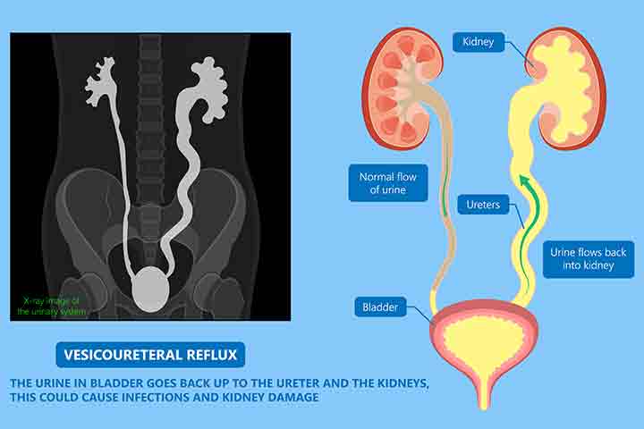 Vesicoureteral reflux causes urine backflow, hydronephrosis in babies