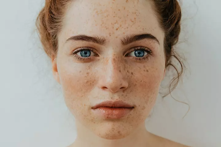 What Causes Freckles