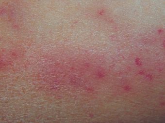 Petechiae In Children: Causes, Symptoms And Treatment