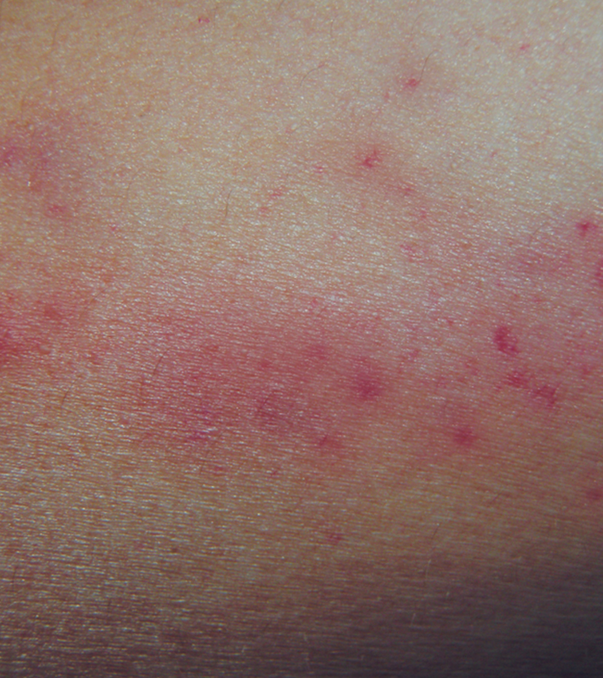 Petechiae In Children: Causes, Symptoms And Treatment