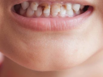 Gingivitis In Children: Types, Causes, Symptoms, And Treatment
