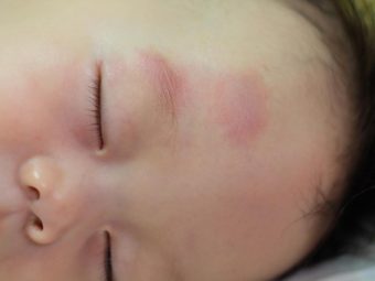 What Causes Bruising In Infants And How To Treat?