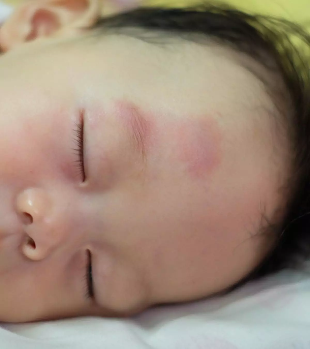 Bruising In Babies:  Is It Normal, Causes And Treatment