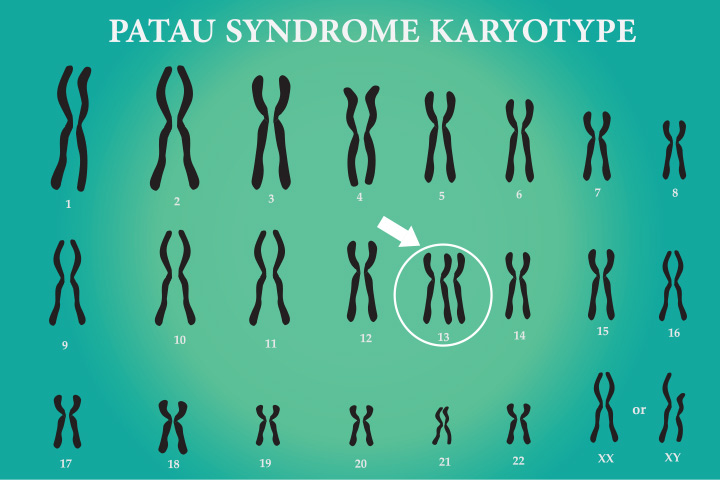 Patau syndrome (Trisomy 13) could be a cause for polydactyl in babies 