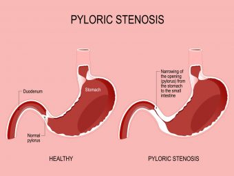 Pyloric Stenosis In Babies: Symptoms, Causes And Treatment