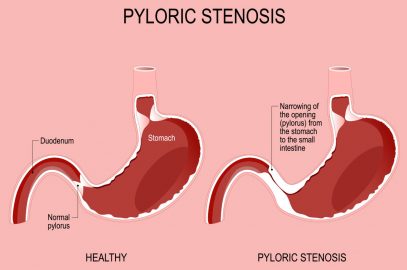 Pyloric Stenosis In Babies: Symptoms, Causes And Treatment