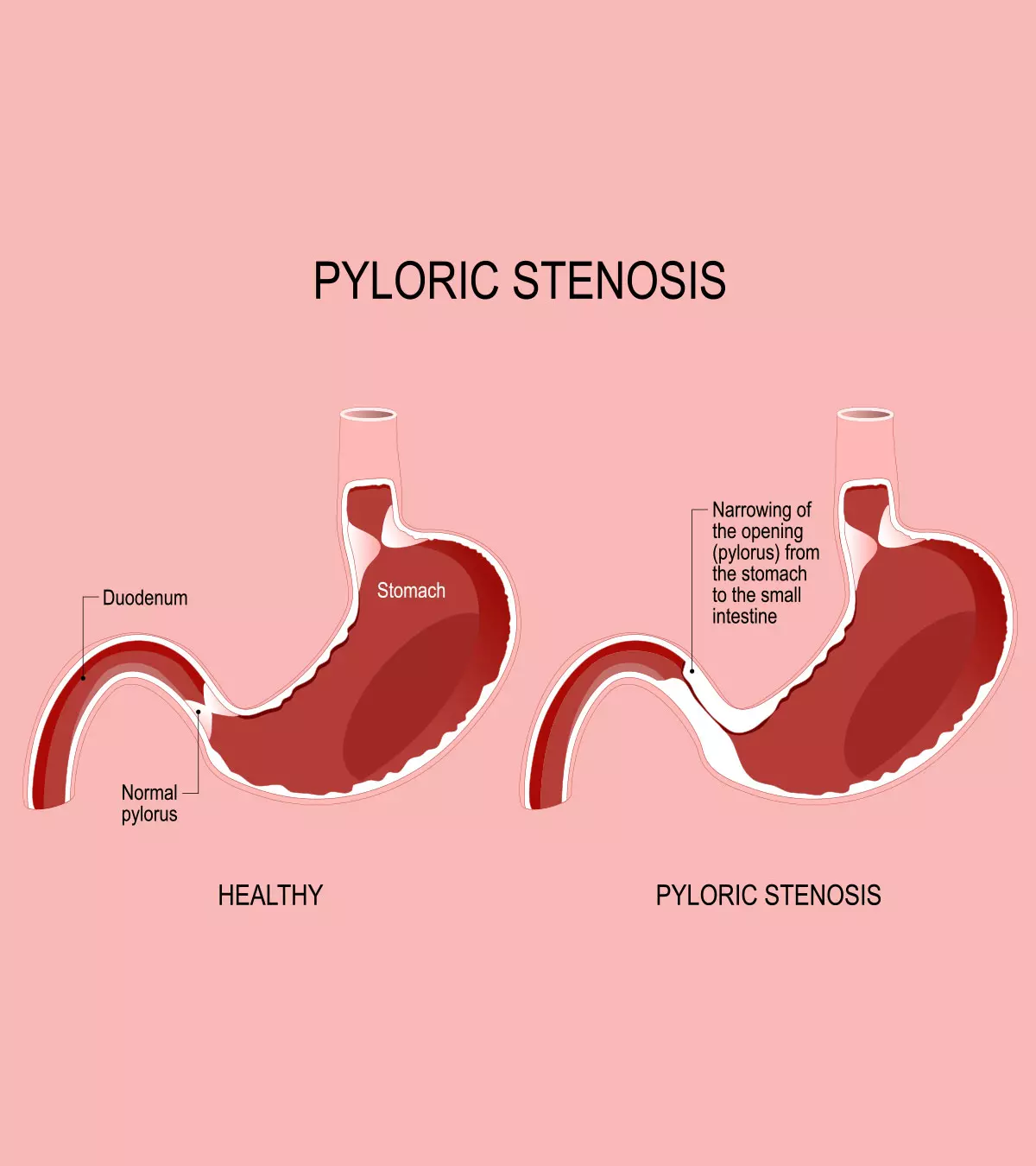 Pyloric Stenosis In Babies Symptoms, Causes, And Treatment