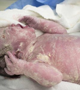 What Is Vernix Caseosa (White Stuff) On Babies And Its Benefits