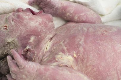 Vernix Caseosa: What It Is, Benefits And Risks For Baby