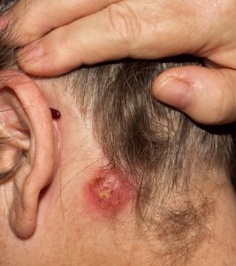 Staph Infections In Kids: Causes, Symptoms, Treatment, And Remedies