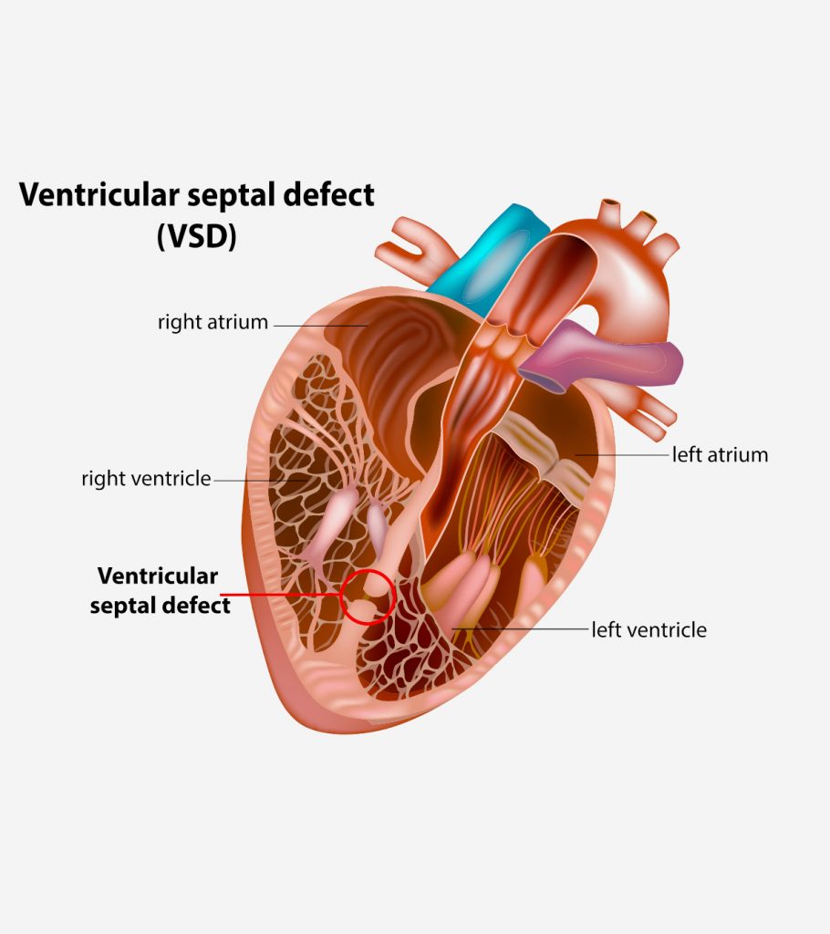 Ventricular Septal Defect VSD In Babies Sign