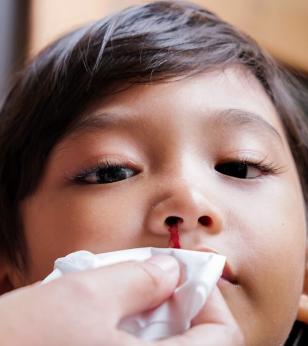 Nosebleeds In Children: Symptoms, Causes And Treatment
