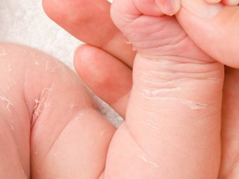 शिशुओं की रूखी त्वचा के कारण, लक्षण व घरेलू उपाय | Baby ki Dry Skin Care In Hindi