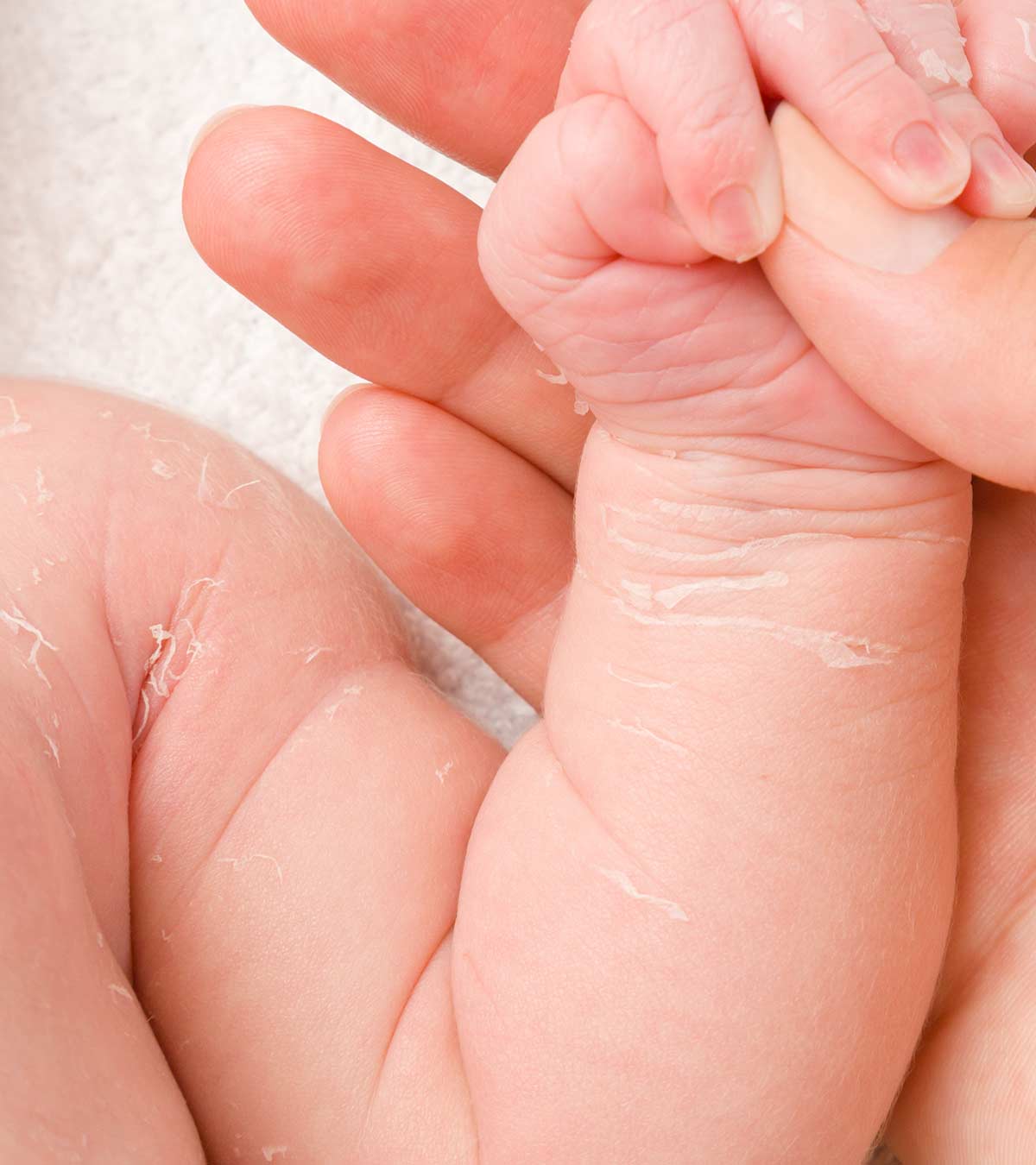 शिशुओं की रूखी त्वचा के कारण, लक्षण व घरेलू उपाय | Baby ki Dry Skin Care In Hindi