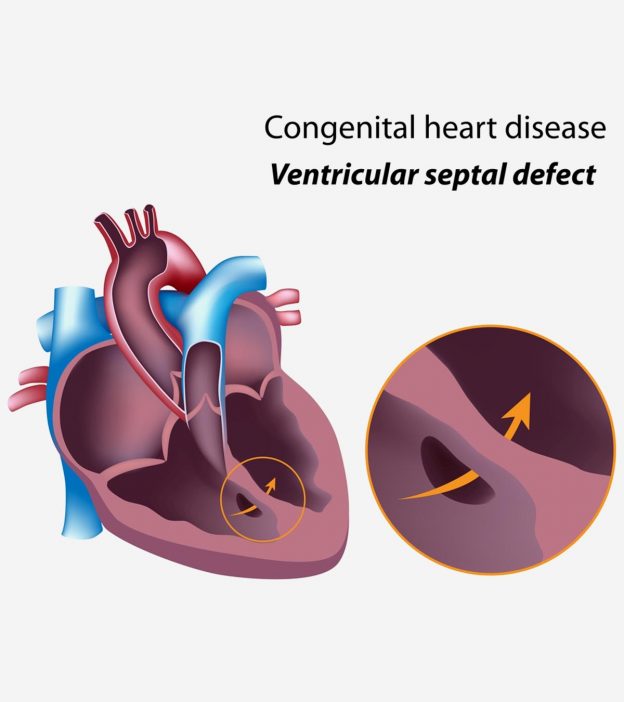 6 Types Of Congenital Heart Disease In Children, Signs & Causes