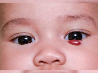 Strawberry Birthmark (Infantile Hemangioma): Causes And Treatment