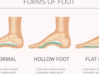 5 Causes Of Flat Feet In Children, Symptoms And Treatment