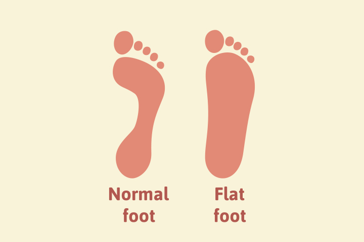 Flat feet in children