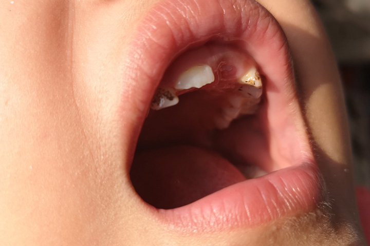 Loss of tooth, Abscess tooth in children