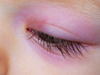 Swollen Eyes In Babies: Causes, Home Remedies & Treatment