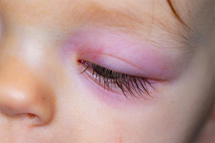 understanding-eyelid-drooping-causes-symptoms-and-treatment-options