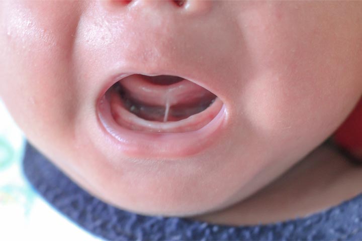 Tongue-tied Baby Symptoms, Causes And Treatment-1