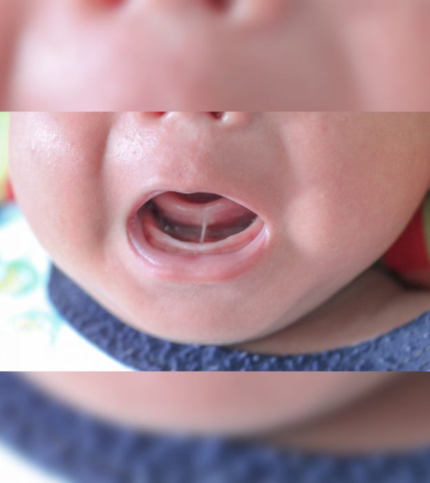 Tongue Tie In Babies: Causes And Treatment