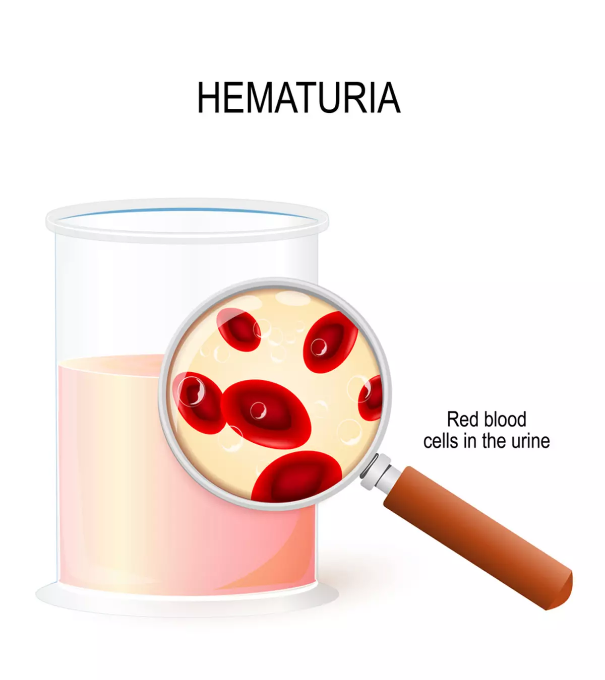 Blood In Urine (Hematuria)