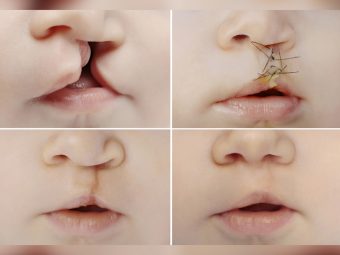 Baby With Cleft Lip (Palate): Types, Causes And Treatment