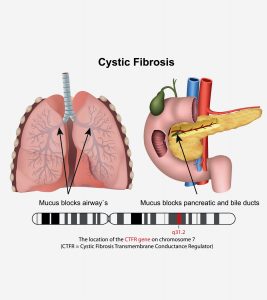 Cystic Fibrosis In Babies: Symptoms, Causes And Treatment