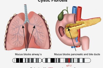 Cystic Fibrosis In Babies: Causes, Symptoms And Treatment best