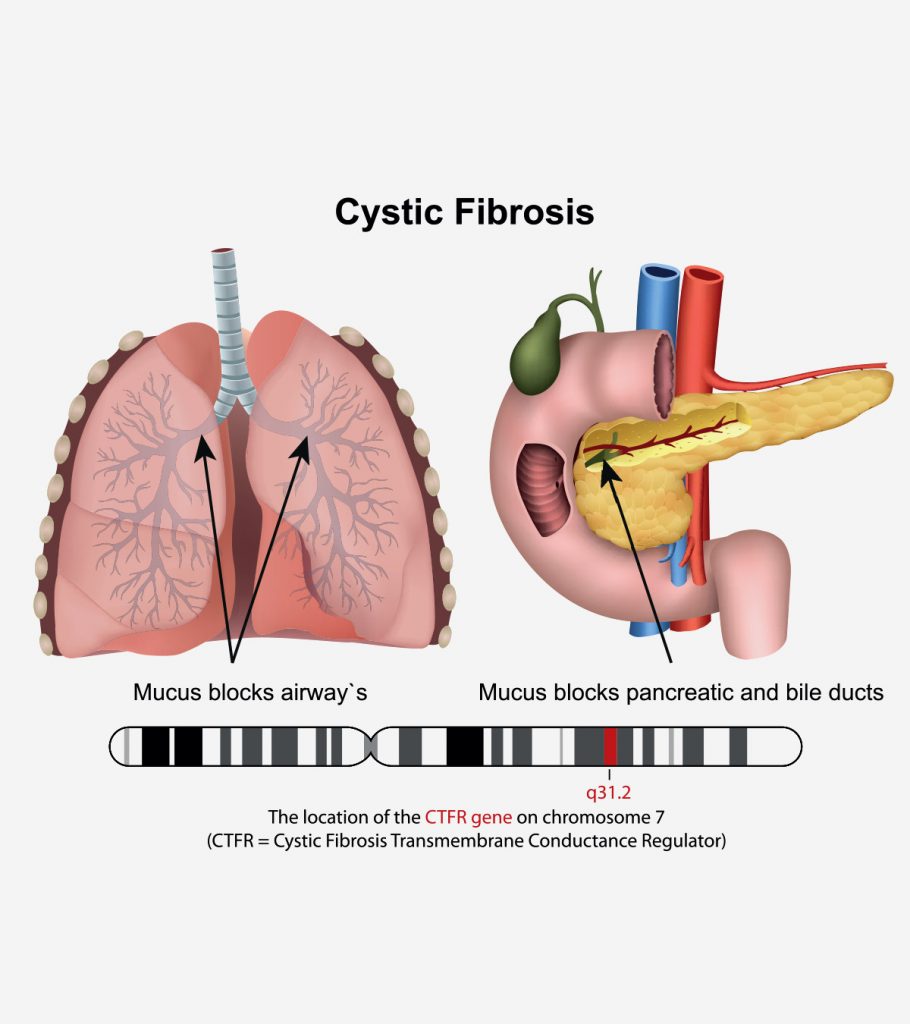 cystic fibrosis case study pediatric