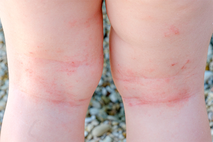 Flea bites can cause skin irritation 