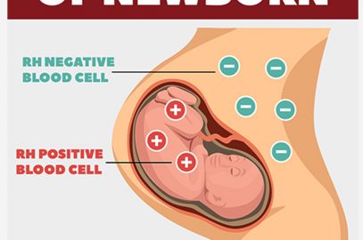 Hemolytic Disease of the Newborn (HDN): Causes And Treatment