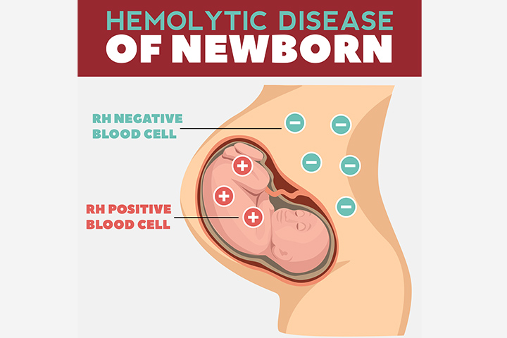 Hemolytic Disease of the Newborn (HDN) Causes And Treatment
