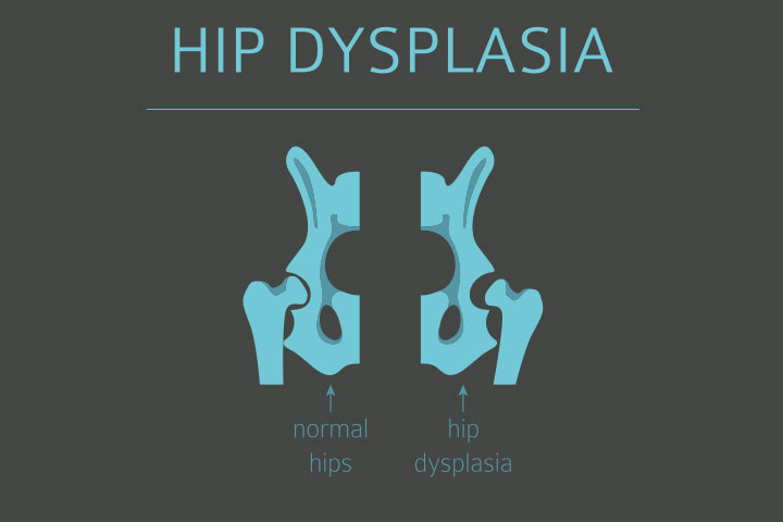 Hip dysplasia, breech babies birth defects
