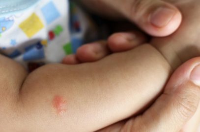 Malaria In Babies: Causes, Symptoms, Treatment And Prevention
