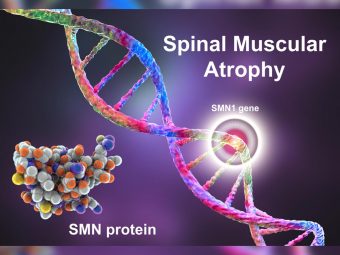 Spinal Muscular Atrophy (SMA) in Infants: Types, Causes And Management