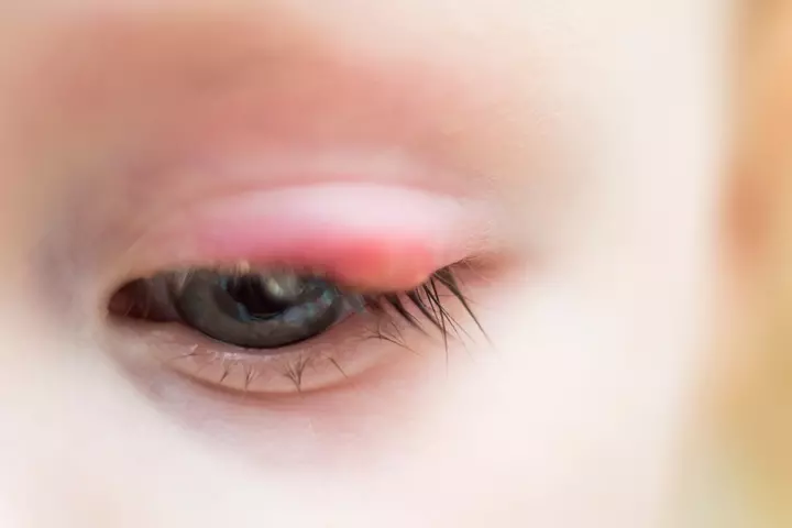 Stye due to staph infection 