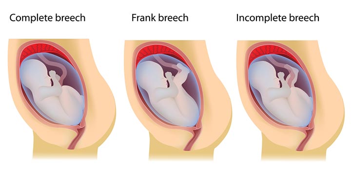 Types Of Breech Babies