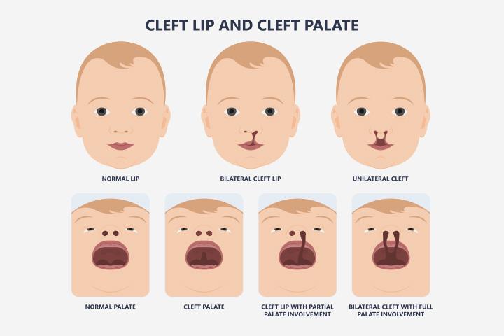 Cleft Palate Types