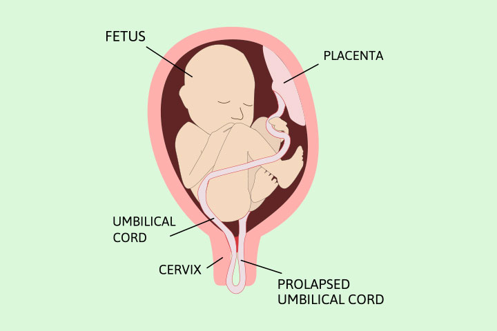 Umbilical cord prolapse is a significant breech delivery issue