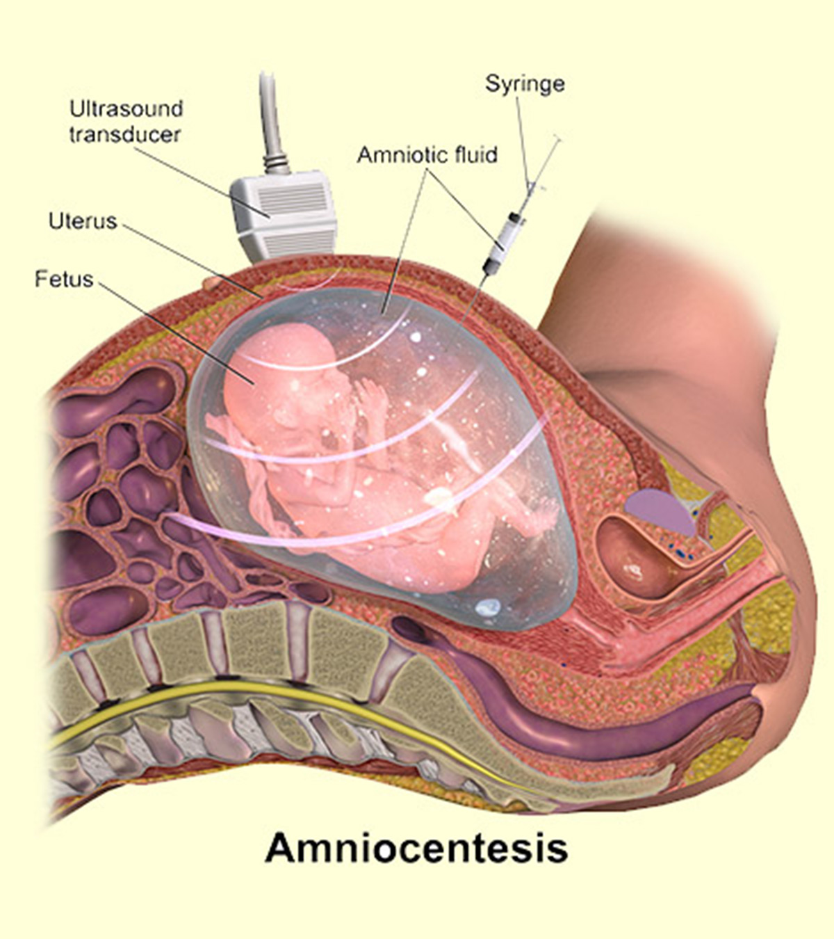 एम्नियोसेंटेसिस टेस्‍ट: प्रक्रिया, परिणाम व लागत  | Amniocentesis Test In Hindi