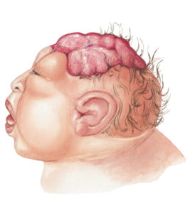 Anencephaly In Babies: Causes, Symptoms And Treatment