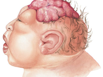Babies With Anencephaly: Causes, Diagnosis And Treatment