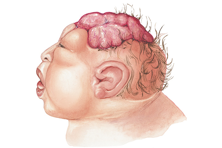 Anencephaly In Babies Causes, Symptoms And Treatment