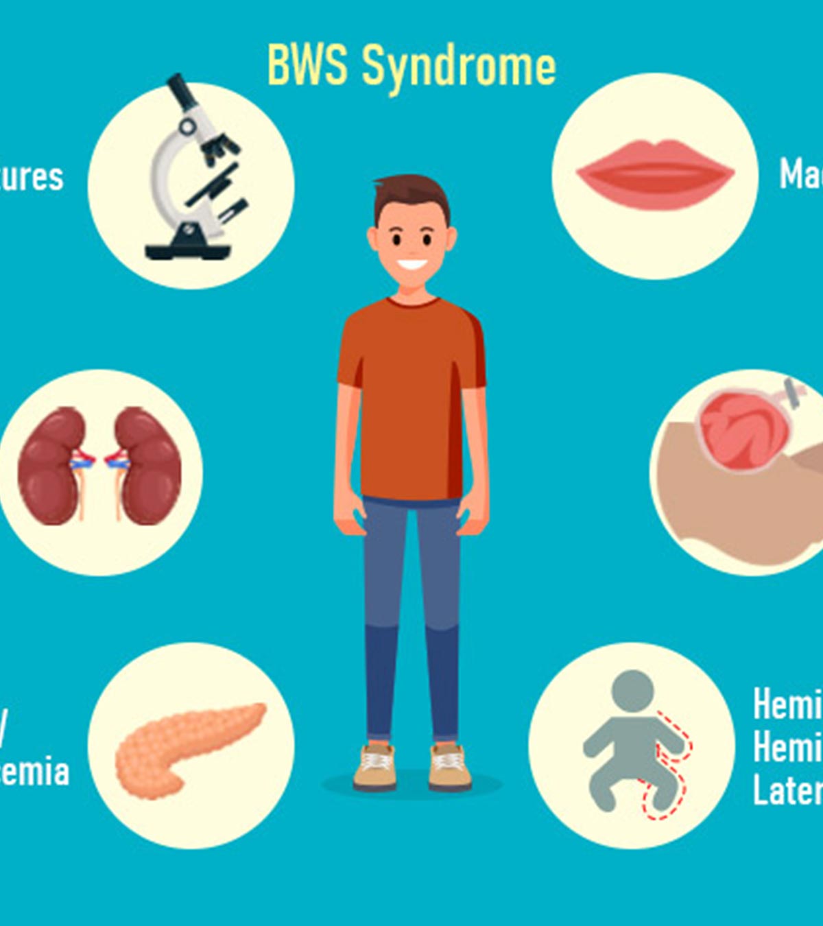 Beckwith-Wiedemann Syndrome In Babies: Causes & Treatment